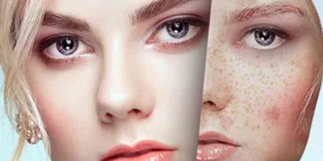 How to Get Rid of Blemishes on the Face Easily