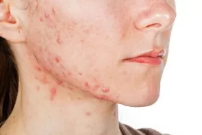 6 Tips For Pimples On Chin And Neck