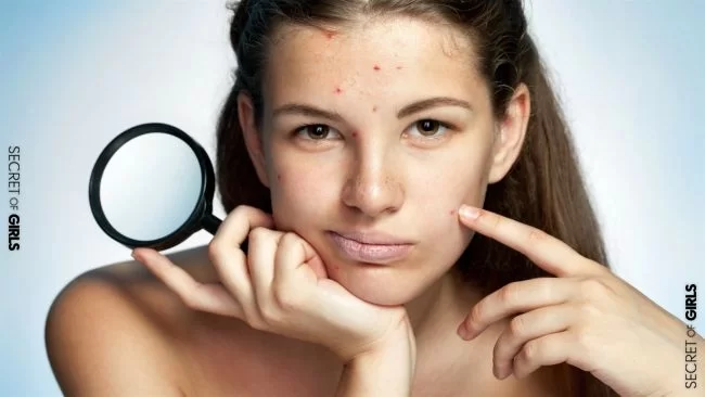 8 Ways To Get Rid Of Acne Now And For