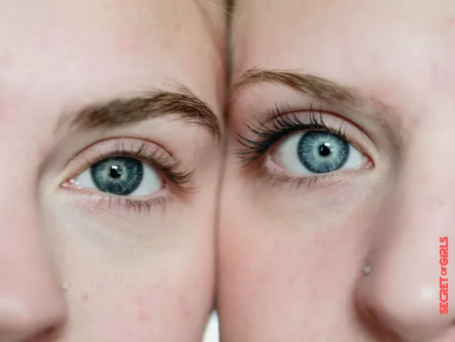 3 Types Of Dark Circles And How To Fight Them?