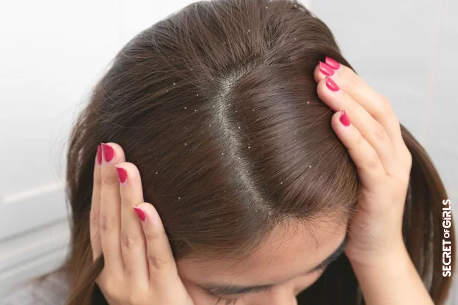 Oily dandruff | Dandruff: Our Best Tips To Get Rid Of It And Never Come Back!