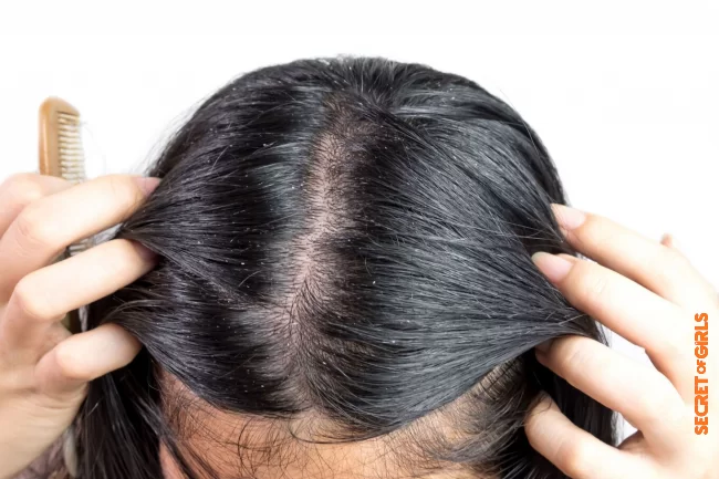 Dry dandruff | Dandruff: Our Best Tips To Get Rid Of It And Never Come Back!
