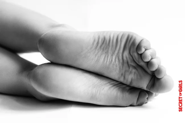 Remove Calluses: Best Tips For Supple Feet