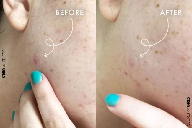 Reviewed: I Tried the Killa Cystic Acne Patches and OMG