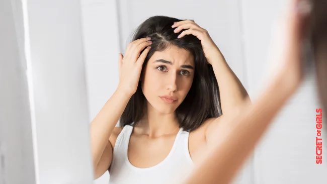 Hair: What causes dandruff? | Dandruff: Ways to Get Rid of Dandruff