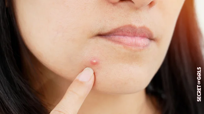 Pimple On Chin? Why They Arise - And What Really Helps? | Pimple On Chin? Why They Arise - And What Really Helps?