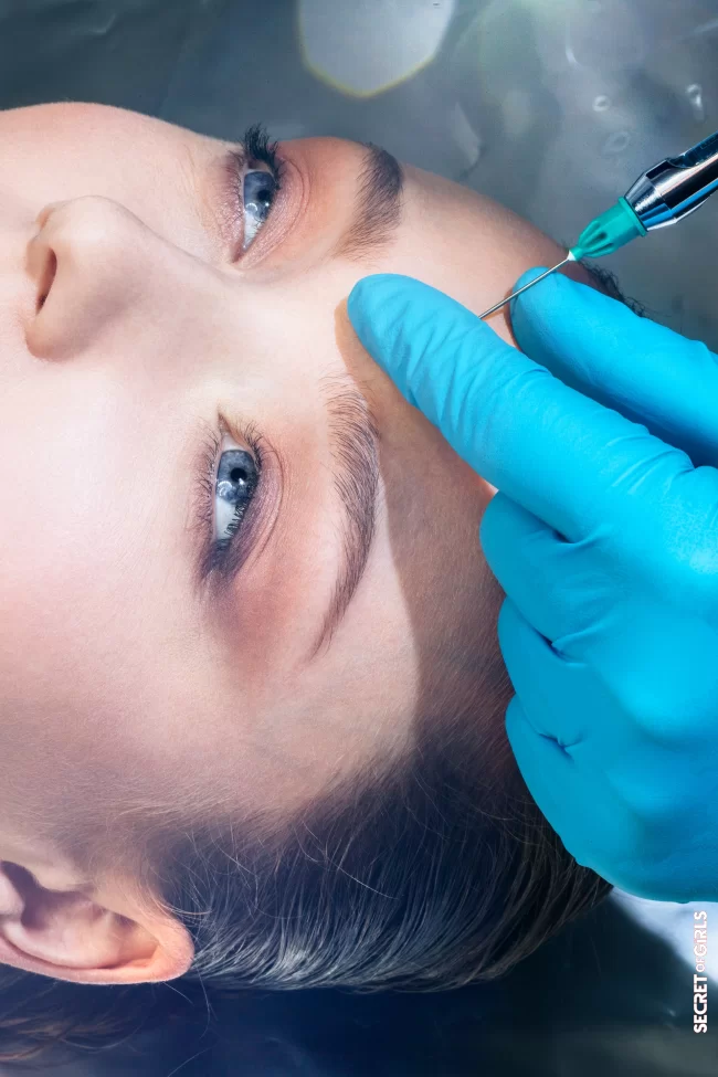Dermal fillers are becoming more and more popular - are they too extreme or soon normal?