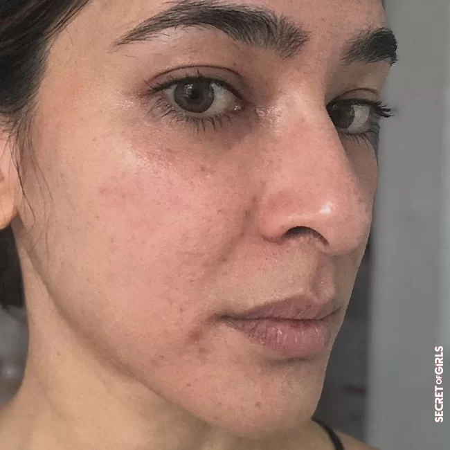 From the beginning, I got spots and scars from acne | Acne: This dermatologist knows what helps - because she herself was affected for years